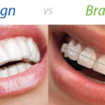 Invisalign dan Aligner