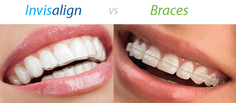 Invisalign dan Aligner