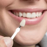 Veneer Direct dan Indirect