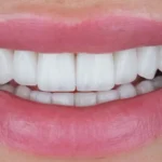 Spesialis Veneer Gigi Tanjung Duren Jakarta Barat