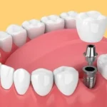Dental Implant