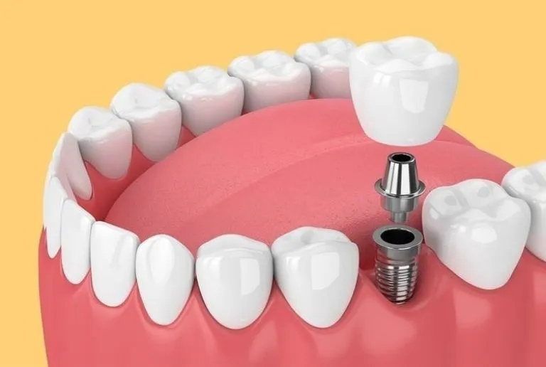 Dental Implant