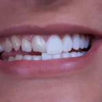 Veneer Gigi Bisa Bertahan Berapa Lama?