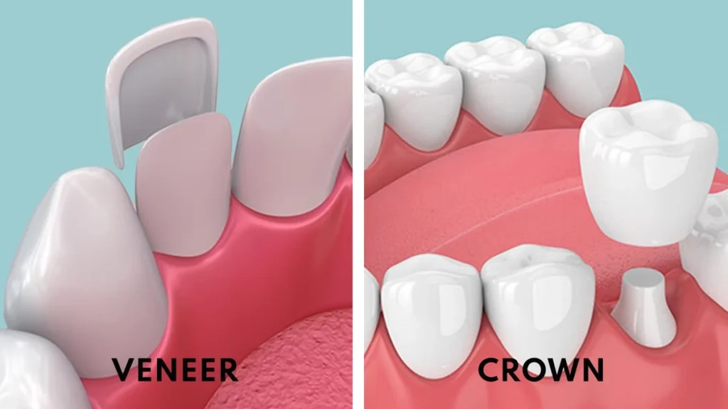 Veneer Gigi dan Crown Gigi