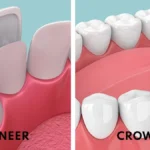 Veneer Gigi dan Crown Gigi