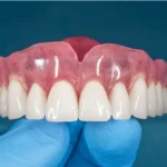 jenis janis gigi palsu