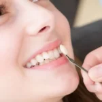 Apakah Veneer Gigi Bisa Dilepas