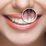 Berapa Lama Proses Pemasangan Implan Gigi?