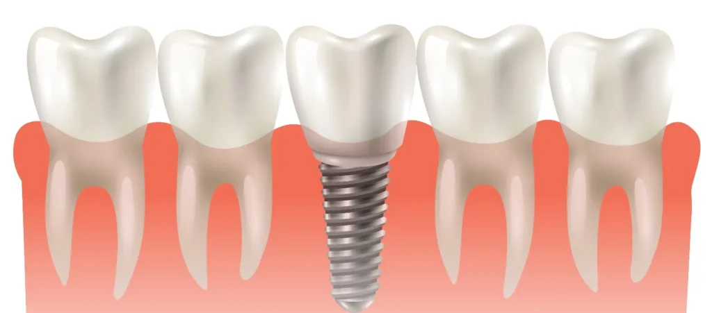 Berapa Lama Proses Pemulihan Setelah Tanam Implan Gigi?
