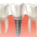Berapa Lama Proses Pemulihan Setelah Tanam Implan Gigi?