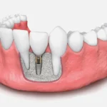 Bone Graft Implan Gigi