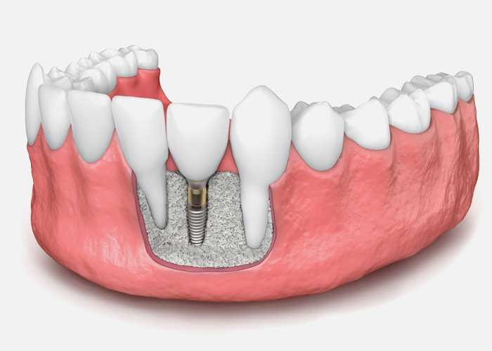 Bone Graft Implan Gigi