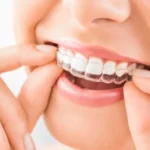 Berapa Lama Pemakaian Invisalign?
