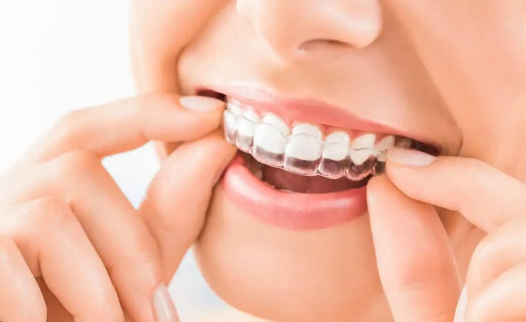 Berapa Lama Pemakaian Invisalign?
