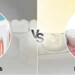 Perbedaan Implan Gigi dan Crown Gigi