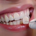 Veneer Gigi Bisa Mengatasi Gigi Tonggos