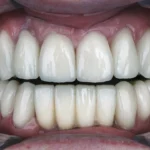 apakah veneer gigi sakit